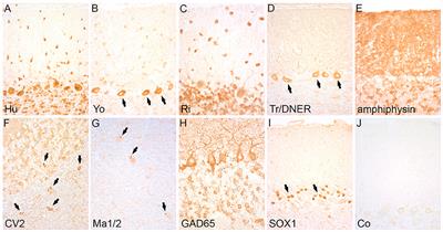 Detection Methods for Autoantibodies in Suspected Autoimmune Encephalitis